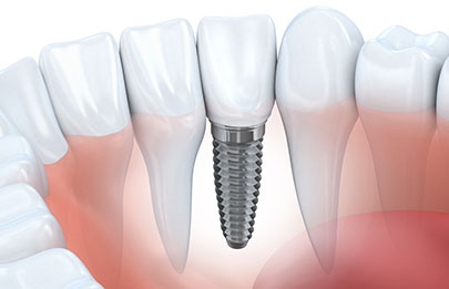 失った歯の機能を取り戻すインプラント治療