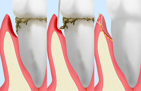 歯茎の中を掃除する歯周ポケット掻爬術