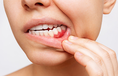 肥大・増殖した歯茎を切除する歯肉切除術